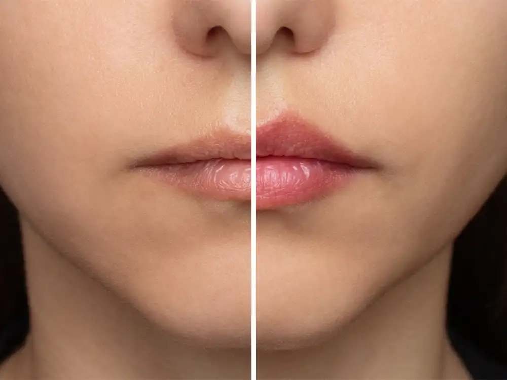 dudak büyütme işlemi öncesi sonrası