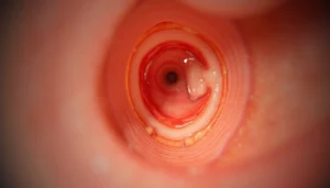 Kulak zarı delinmesi otoskopik muayene görünümü, timpanik membran perforasyonu