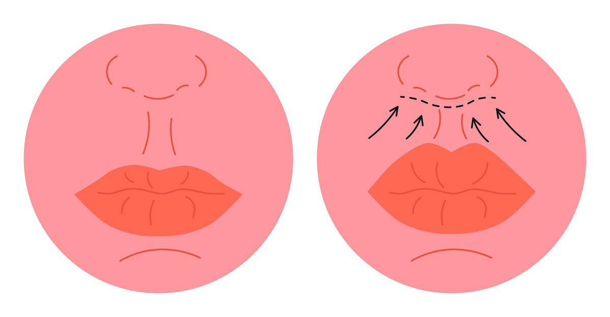 Lip Lift Dudak Kaldırma Ameliyatı