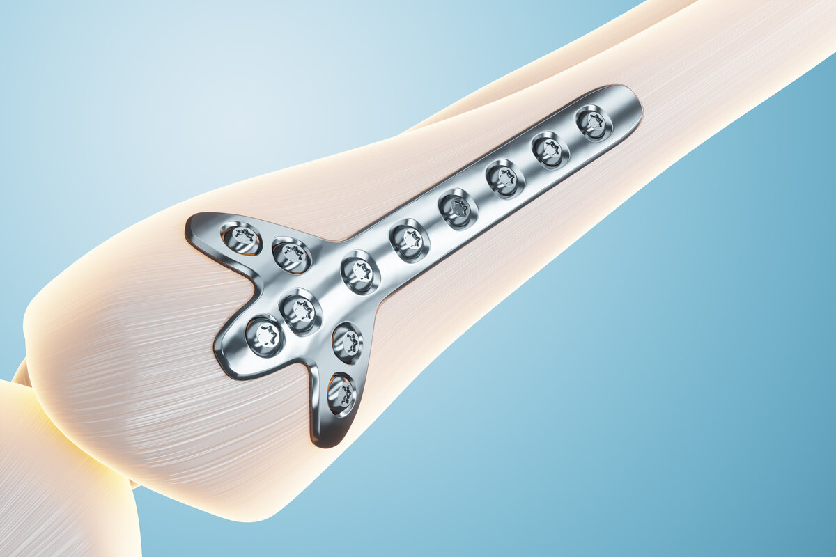 Mikromotor Rinoplasti Tekniği